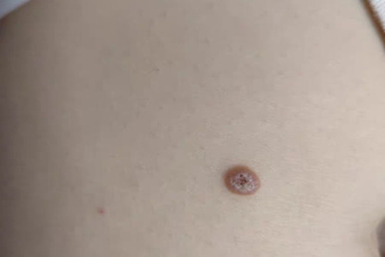 局限型表皮痣腹部症状图 局限型表皮痣腹部症状图