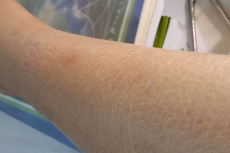 甲状腺功能减退症小腿皮肤粗糙图