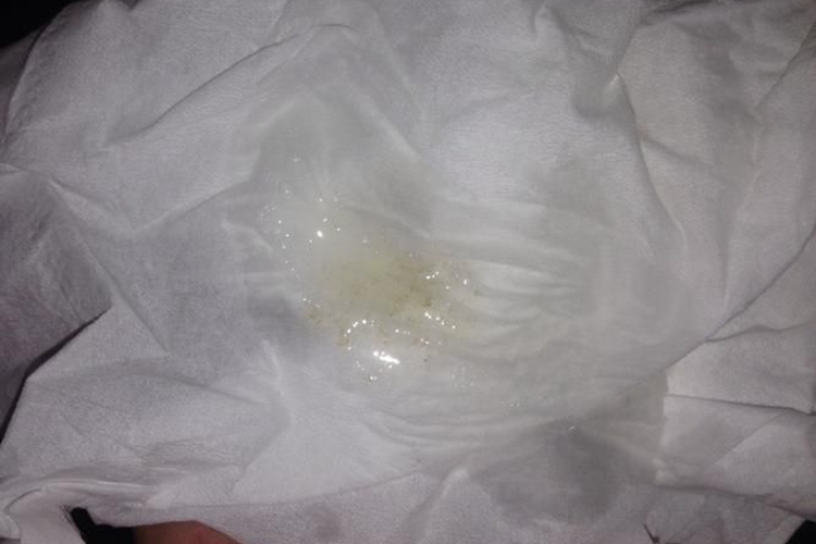 肺结核白色黏痰图