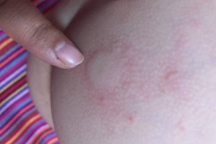 新生儿疖图 新生儿疖图