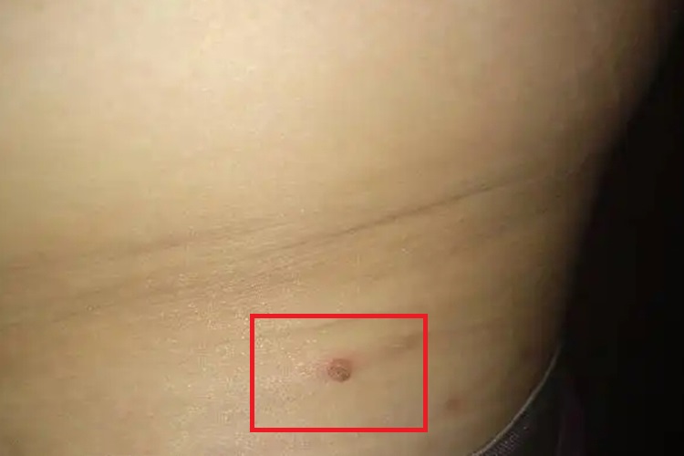 腰部长寻常疣图