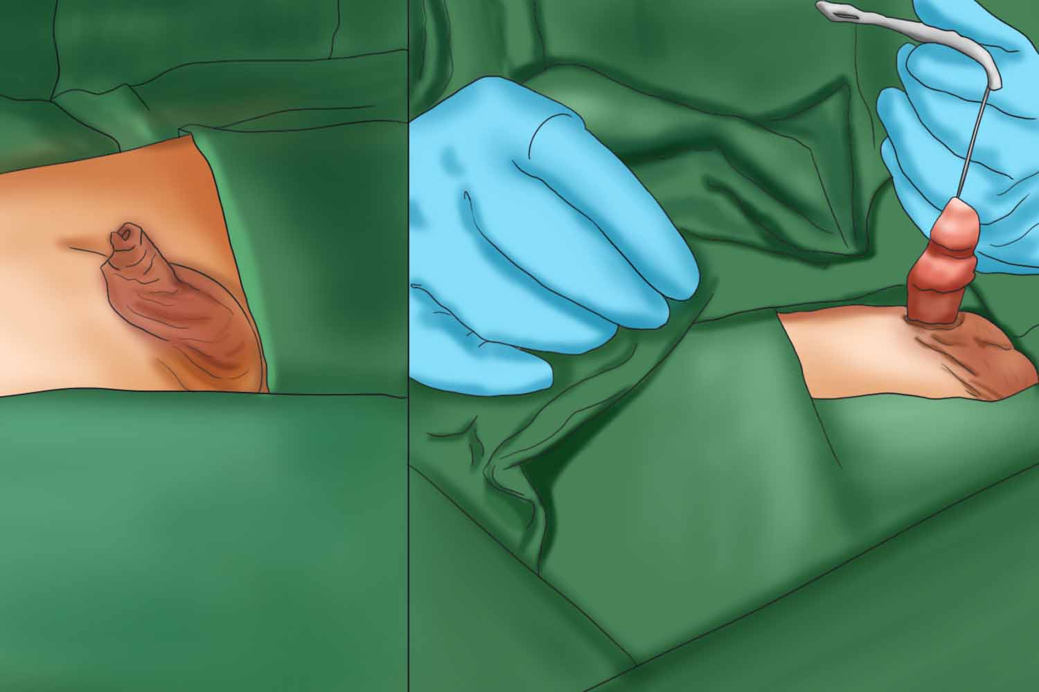 小朋友做完隐匿阴茎手术前后图 小朋友做完隐匿阴茎手术前后图