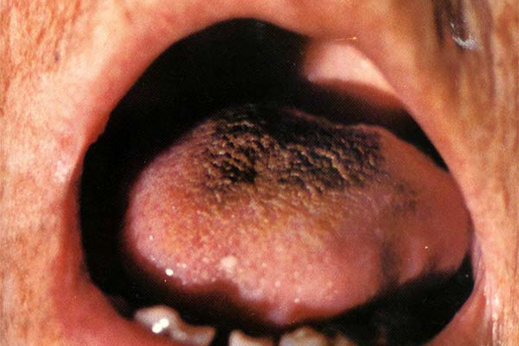 灰黑苔者舌苔图