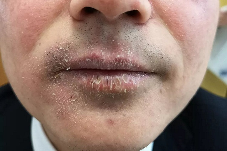 光线性唇炎嘴唇白斑图 光线性唇炎嘴唇白斑图