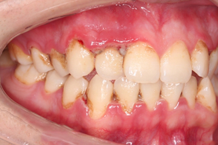 坏死性溃疡性龈口炎牙龈糜烂图