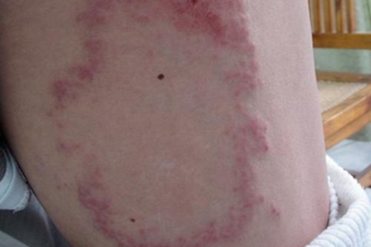 界限类偏结核样型麻风小腿红斑图