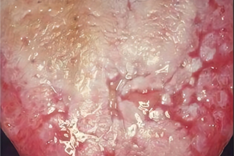 舌扁平苔藓舌头症状图 舌扁平苔藓舌头症状图