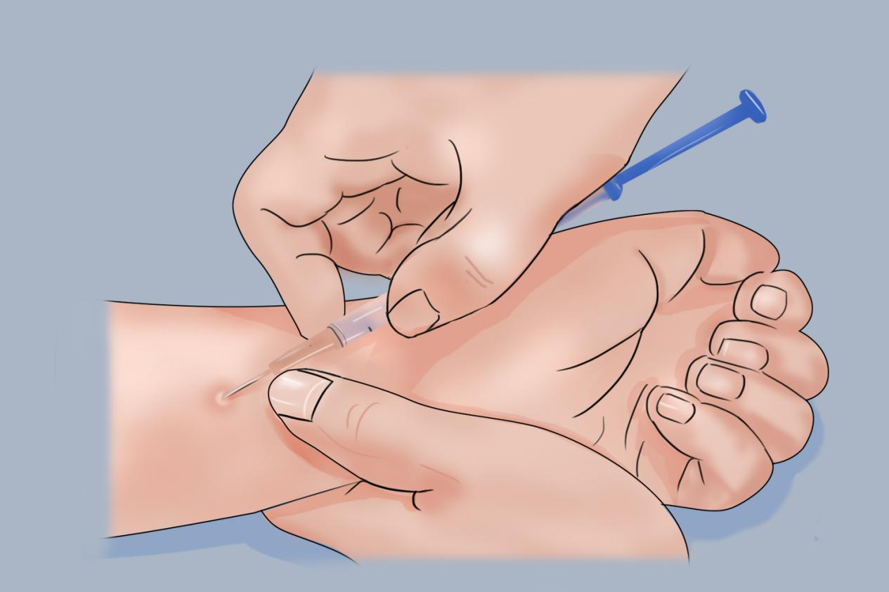 5°角持针注射图