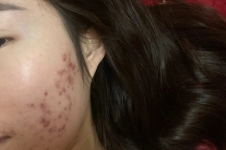 痤疮皮损消退图