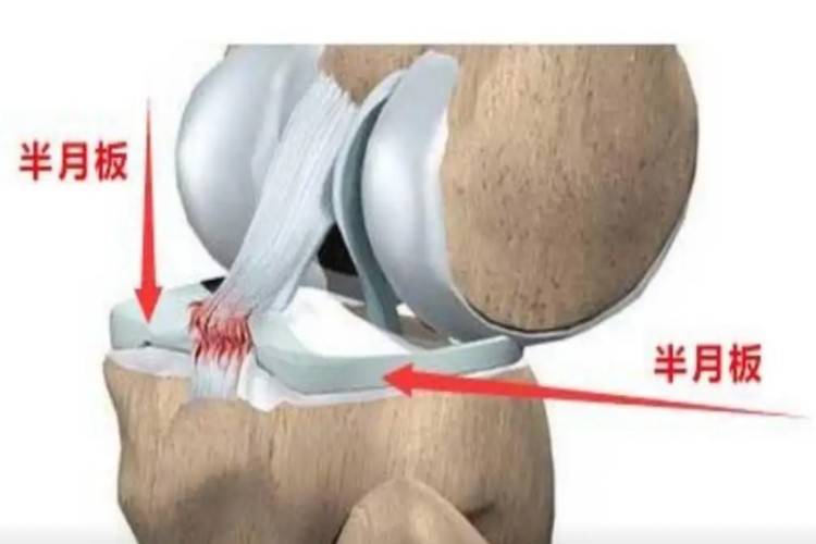 半月板示意图