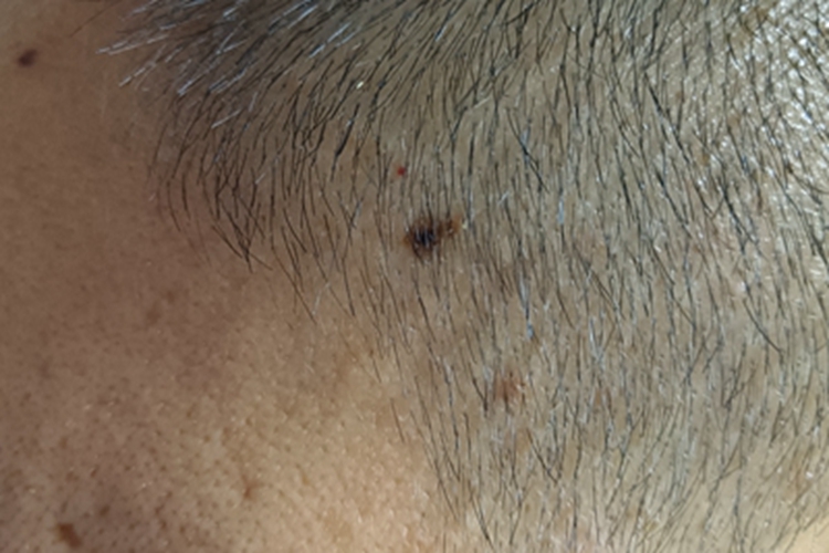 交界痣头皮症状图 交界痣头皮症状图