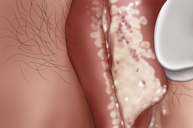 女性淋球菌尿道感染图