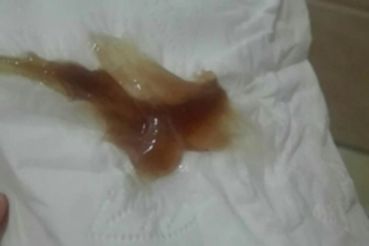 围排卵期出血褐色分泌物图