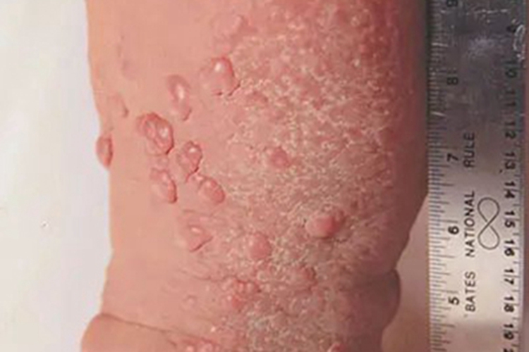 结节型黏液水肿性苔藓小腿疙瘩图