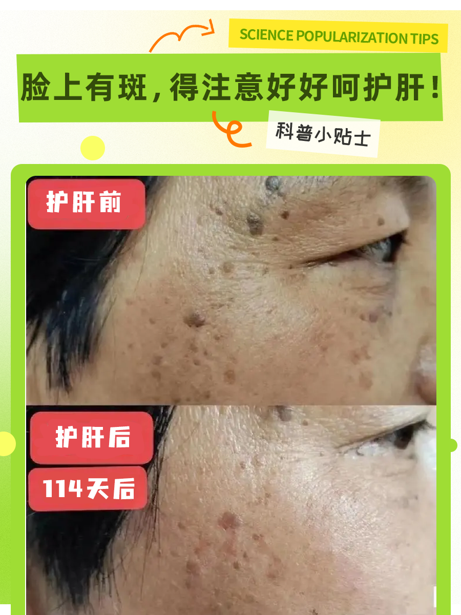 肝斑调理经验分享:中医视角解读!