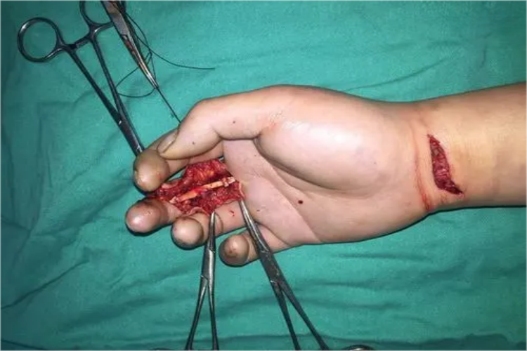 右手中指肌腱断裂图 右手中指肌腱断裂图