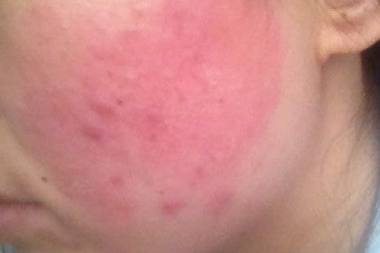 辣椒过敏脸部红肿图