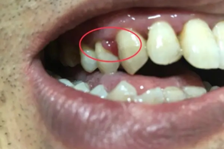 牙龈息肉图 牙龈息肉图