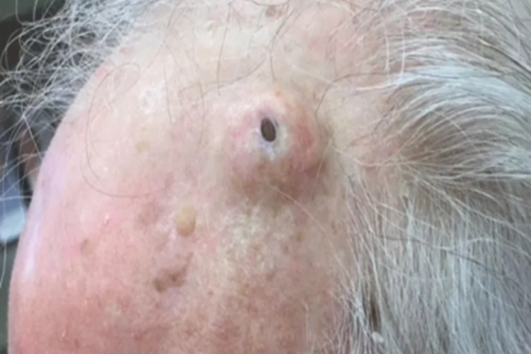 扩张孔前额症状图