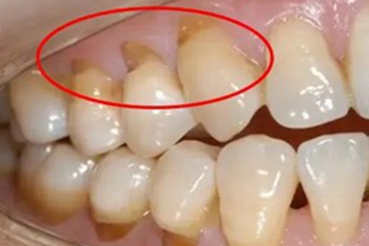 楔状缺损牙根少了一块图