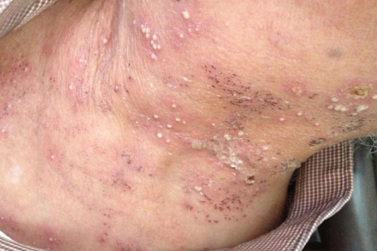 脖子上带状疱疹图