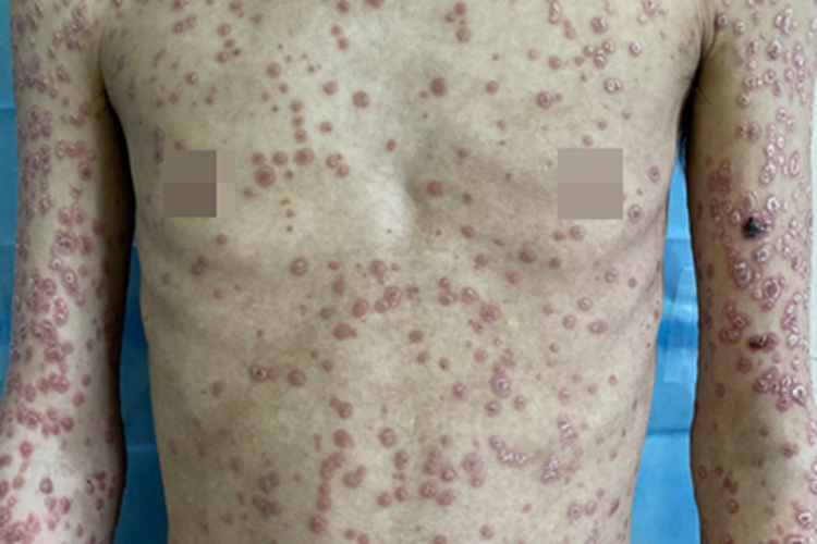 男性三期梅毒上半身症状图