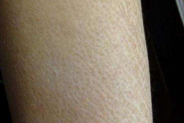 缺铁性贫血皮肤粗糙图