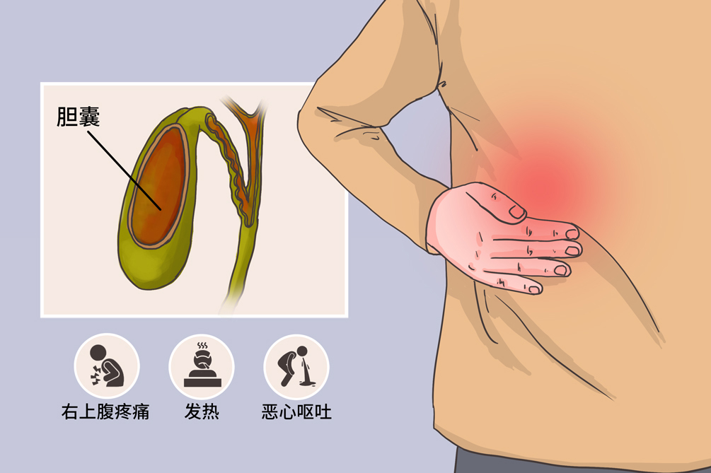 女性胆囊炎疼痛位置图