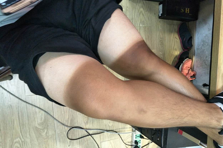 日晒伤小腿皮肤发黑图