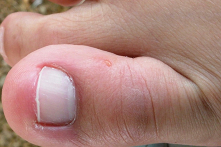 蚁蜇伤脚趾红肿图