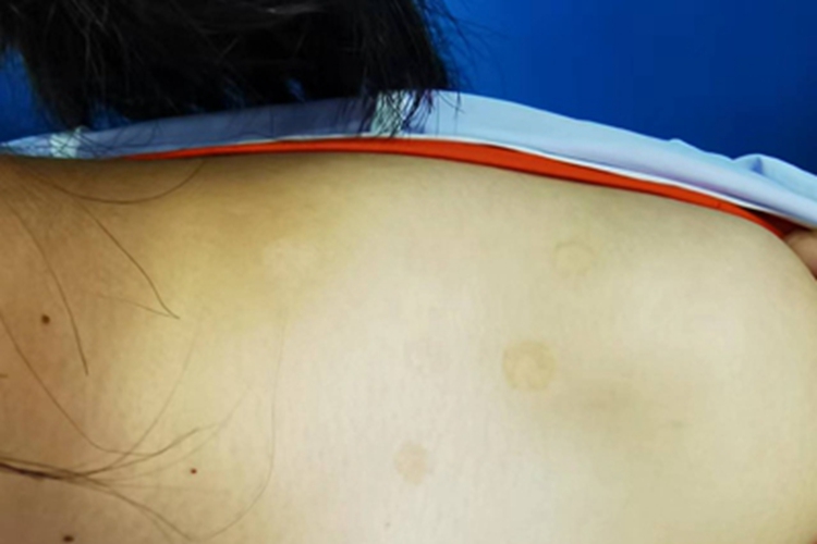 花斑糠疹左肩上有几个圆斑图