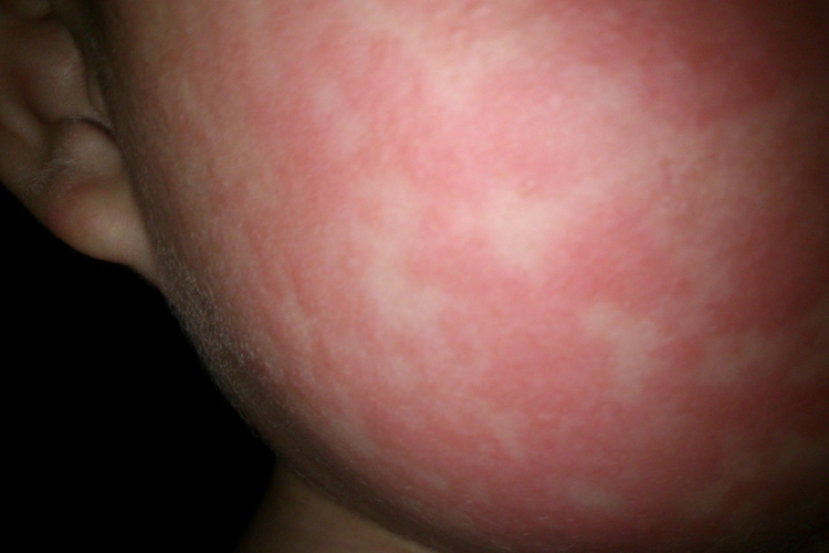 发烧后脸上起麻疹图 发烧后脸上起麻疹图