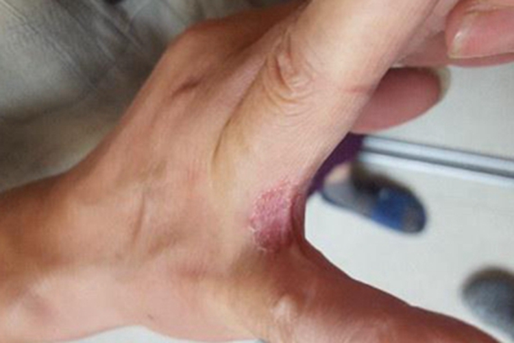 念珠菌性间擦疹手指缝症状图 念珠菌性间擦疹手指缝症状图