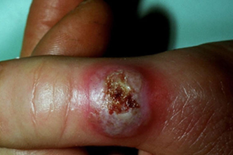 羊痘结节图 羊痘结节图