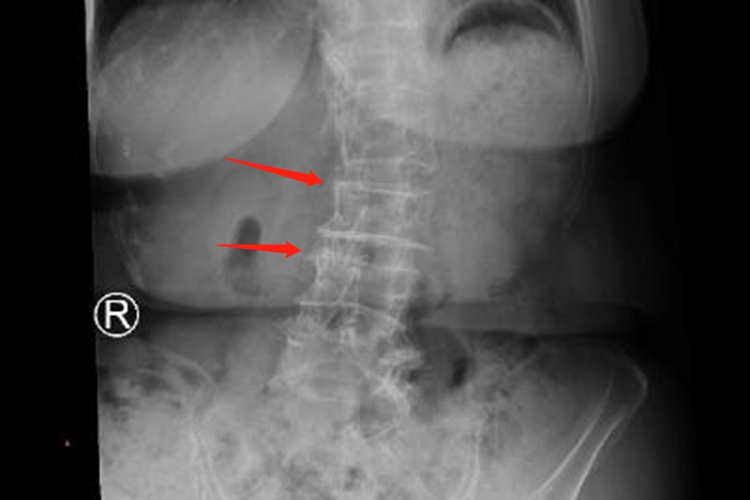 退行性脊柱侧弯症状图 退行性脊柱侧弯症状图