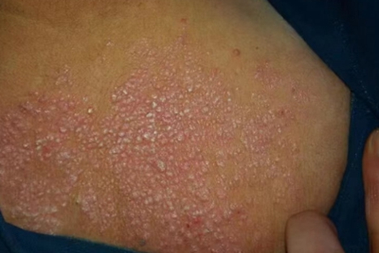 播散性神经性皮炎丘疹图