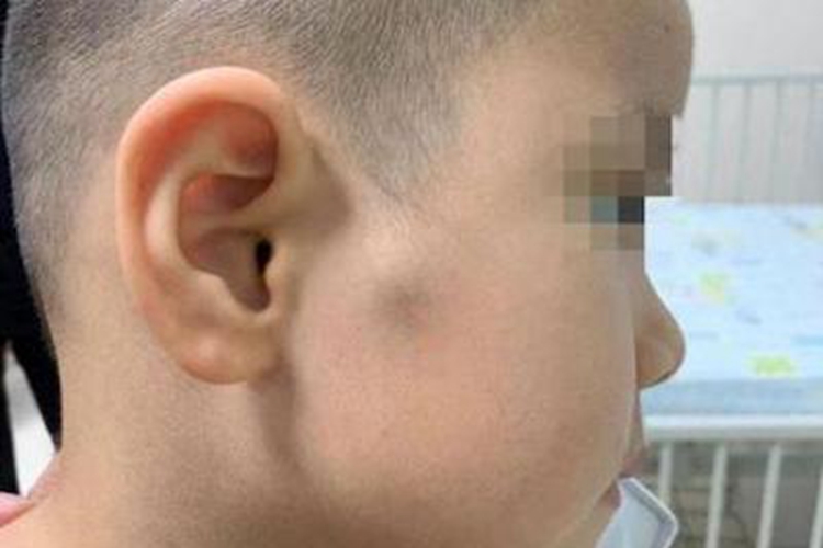 毛母质瘤耳前肿块图 毛母质瘤耳前肿块图