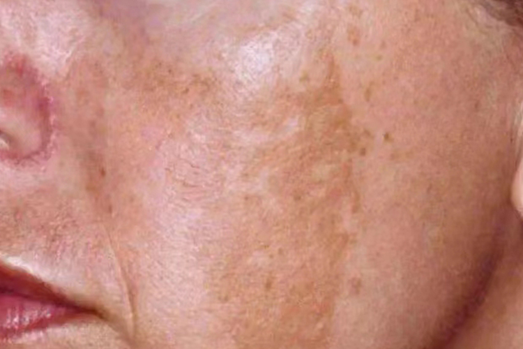 黄褐斑脸部图
