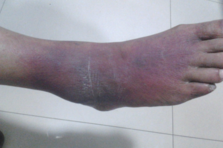 细菌感染性淋巴水肿脚背发紫图