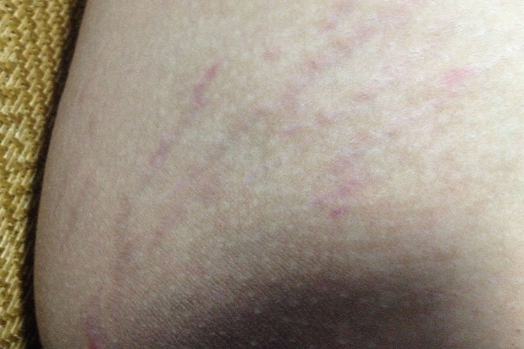 女性大腿内侧生理性色素沉着图