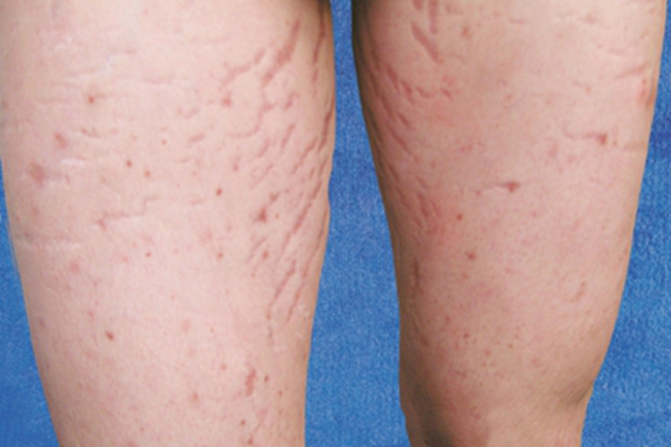 大腿内侧萎缩纹图