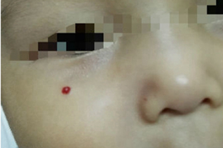 樱桃状血管瘤面部红点图