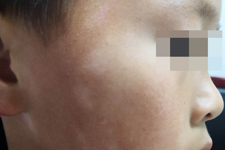 白色糠疹白斑初期图