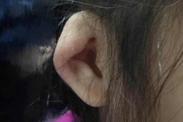 中度杯状耳耳廓症状图 中度杯状耳耳廓症状图