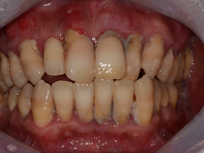 牙龈炎图片 早期症状图片
