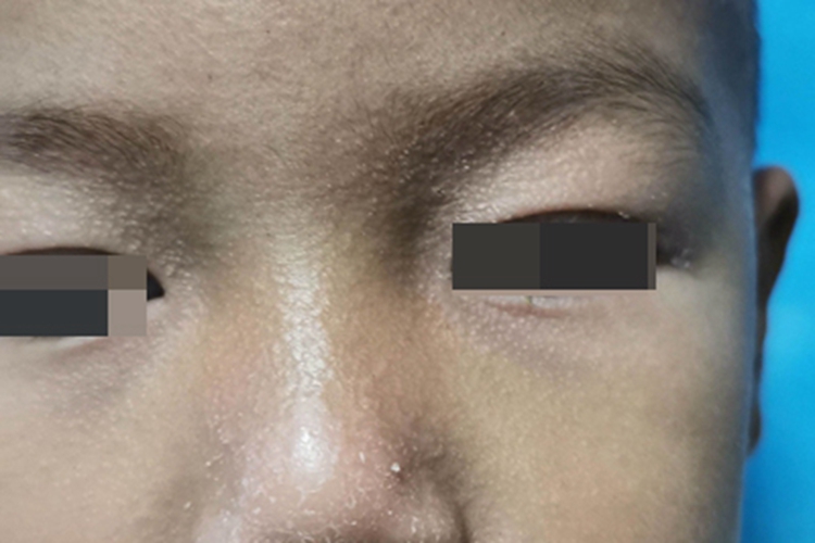 毛发红糠疹面部脱屑图 毛发红糠疹面部脱屑图