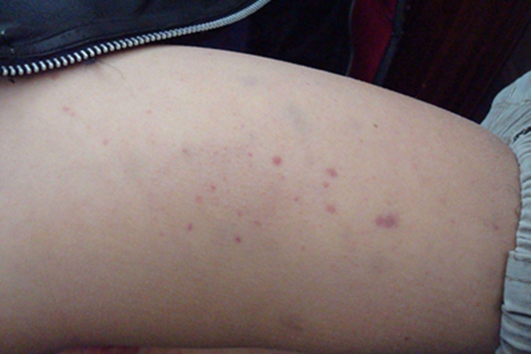 单纯性紫癜大腿症状图 单纯性紫癜大腿症状图