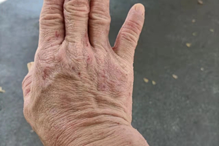 慢性湿疹手背血痂图