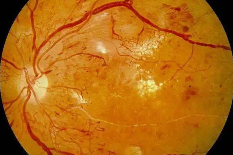 高血压性视网膜病变图