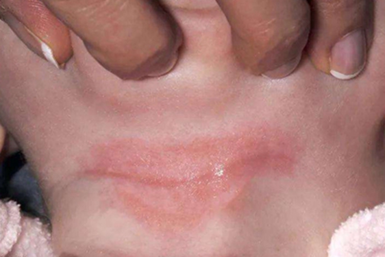 渗出型婴儿湿疹颈部症状图